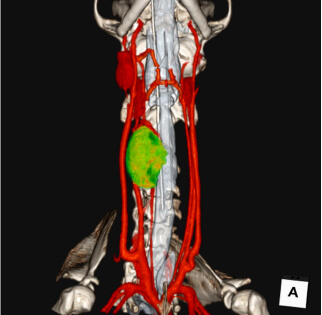 甲状腺の腫瘍3D